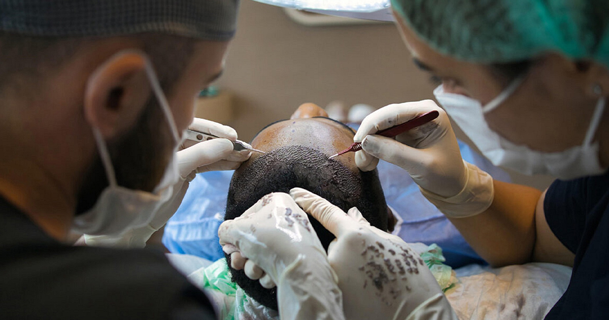 Implante Capilar: Precio. Fotografía de Fuse Hair Delhi 1, Pixabay.